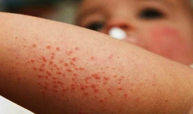 Fallece niño por brote de sarampión en Texas